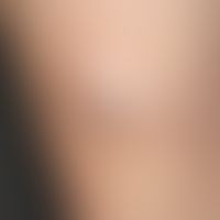 Comedo (giant comedo): approx. 2.0 cm large, firm knot with a black, keratotic centre about 0.3 c...