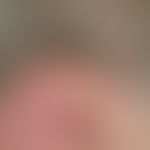 Keratose seborrhoische (papillomatöser Typ):&nbsp;ungewöhliche Lokalisation dieser solitären, völ...