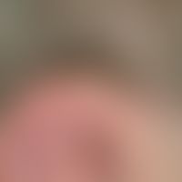 Keratose seborrhoische (papillomatöser Typ):&nbsp;ungewöhliche Lokalisation dieser solitären, völ...