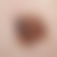 Keratosis seborrheic (plaque type): Flat irregularly bordered pigmented plaque.
