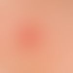 Basal cell carcinoma nodular: Slowly growing, symptomless, surface smooth lump, existing for seve...