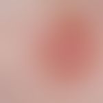 basal cell carcinoma nodular: detail enlargement. nodule with smooth shiny surface. bizarre vascu...