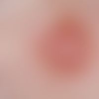 basal cell carcinoma nodular: detail enlargement. nodule with smooth shiny surface. bizarre vascu...