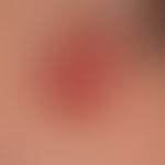 Basal cell carcinoma nodular: Slowly growing, symptomless, surface-smooth, red lump that has exis...