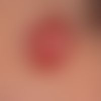 Basal cell carcinoma nodular: Slowly growing, symptomless, surface-smooth, red lump that has exis...