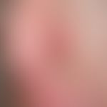 Basal cell carcinoma, nodular. nodule persisting for 3 years, not painful, size: 2.5x 1.0 cm. sha...