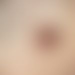 Basalzellkarzinom pigmentiertes: Seit Jahren bestehender, langsam wachsender, scharf begrenzter o...