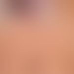 Basalzellkarzinom pigmentiertes: Oberflächliche (superfizielles), mehrgliedrige, symptomlose, tei...