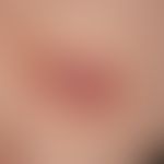 Basal cell carcinoma, superficial: 5.2 x 4.8 cm in size, symptomless, sharply defined scaly plaqu...