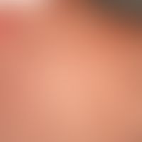 Basal cell carcinoma superficial: Slowly growing, symptom-free plaque with adherent white scales ...