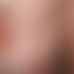 Nodular or nodular basal cell carcinoma. Relatively inconspicuous, sharply defined, completely as...