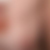 Nodular or nodular basal cell carcinoma. Relatively inconspicuous, sharply defined, completely as...
