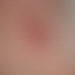 Basal cell carcinoma, nodular. 74-year-old female patient, solitary, continuously growing for 2 y...