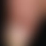 Bowen's disease: Sharply bordered brownish plaque that has existed for 2 years, is completely asy...