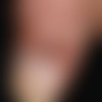 Bowen's disease: Sharply bordered brownish plaque that has existed for 2 years, is completely asy...