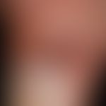 Bowen's disease: detailed view
