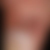 Bowen's disease: detailed view

