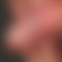 Balanitis plasmacellularis: Chronische Balanitis&nbsp;bei einem 61 Jahre alten Patienten.&nbsp;Eh...