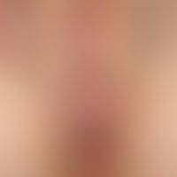 Lichen sclerosus der Vulva: ausgeprägter Lichen sclerosus mit flächenhafter weißlicher Sklerosier...