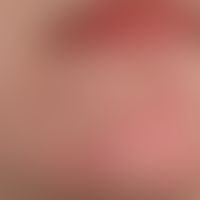 Lichen sclerosus extragenitaler: seit 2 Jahren progredienter Lichen sclerosus mit strickleiterart...