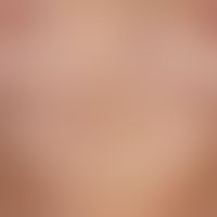 Lichen sclerosus extragenitaler: Diffuse, veil-like, only slightly consistency increased sclerosi...
