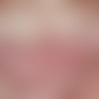 Lichen sclerosus extragenitaler: extensive diffuse reddening with superimposed whitish sclerosis;...