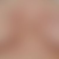 Lichen sclerosus extragenitaler: confetti-like white plaques in surrounding erythema; no signific...