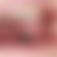 Lichen sclerosus extragenitaler: Lichen planus-artiger Lichen sclerosus der Mundschleimhaut bei b...