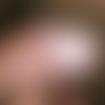 Lichen sclerosus of the penis: pronounced whitish, extensive sclerosing of the glans penis; prepu...