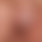 lichen sclerosus of the penis: distinct phimosis in a 4-year-old boy. the lichen sclerosus can st...