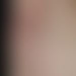 Lichen sclerosus of the axilla: large, less symptomatic, whitish, also reddish, atrophic shiny pl...