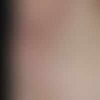Lichen sclerosus der Axilla: großflächige, wenig symptomatische,&nbsp;weißlich, auch rötliche,&nb...