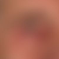 Kontakallergisches Liddermatitis:&nbsp;nachgewiesene Kontaktallergie auf ophthalmologische Medika...