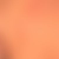 Lyme borreliosis: erythema chronicum migrans, which has been present for several weeks and contin...