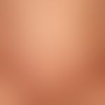 Lyme borreliosis, late stage: symptomless, morphea-like, blurred plaques existing for several mon...
