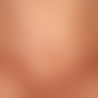 Lyme borreliosis, late stage: symptomless, morphea-like, blurred plaques existing for several mon...