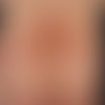 Lyme borreliosis, late stage: symptomless, blurred, morphea-like, painless plaques existing for s...