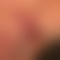 Pemphigus chronicus benignus familiaris: chronic, extremely therapy-resistant, sharply defined, r...