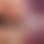Nagelhämatom: auswachsendes Nagelhämatom im direkten Vergleich. Links unten nach 8 Wochen. Rechts...