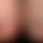 Hämatom, Nagelhämatom: auswachsendes Nagelhämatom . Links Ausgangssituation, rechts 8 Wochen spät...