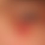 lymphomatoid papulosis: previously known recurrent clinical picture in a 34-year-old female patie...