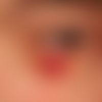 Lymphomatoide Papulose: Vorbekanntes rezidivierendes Krankheitsbild bei einer 34-jährigen Patient...