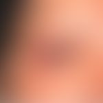 Lymphomatoid papulosis: now misdiagnosed as ulcerative "pyoderma". As it was a multiple relapse o...