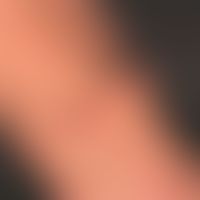 Lymphomatoid papulosis of the flexor-sided forearm; within a few weeks a red, painless lump devel...