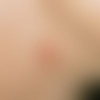 Lymphocytic infiltration of the skin in a 27-year-old, otherwise completely healthy female patien...