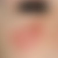 Lymphocytic infiltration of the skin, which is an elastic, flat, reddish infiltrated plaque in th...