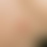 Lymphadenosis cutis benigna. symptomless, solitary, soft, brown-red, dome-shaped bulging, blurred...
