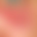 Lymphadenosis cutis benigna: a red, blurred, painless lump that has existed for several months, w...