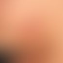 Lymphadenosis cutis benigna: seit 3 Monaten bestehender, schmerzloser nicht juckender&nbsp; kalot...