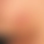 Lymphadenosis cutis benigna: painless, non-itching, calotte-shaped, firm red lump that has been p...